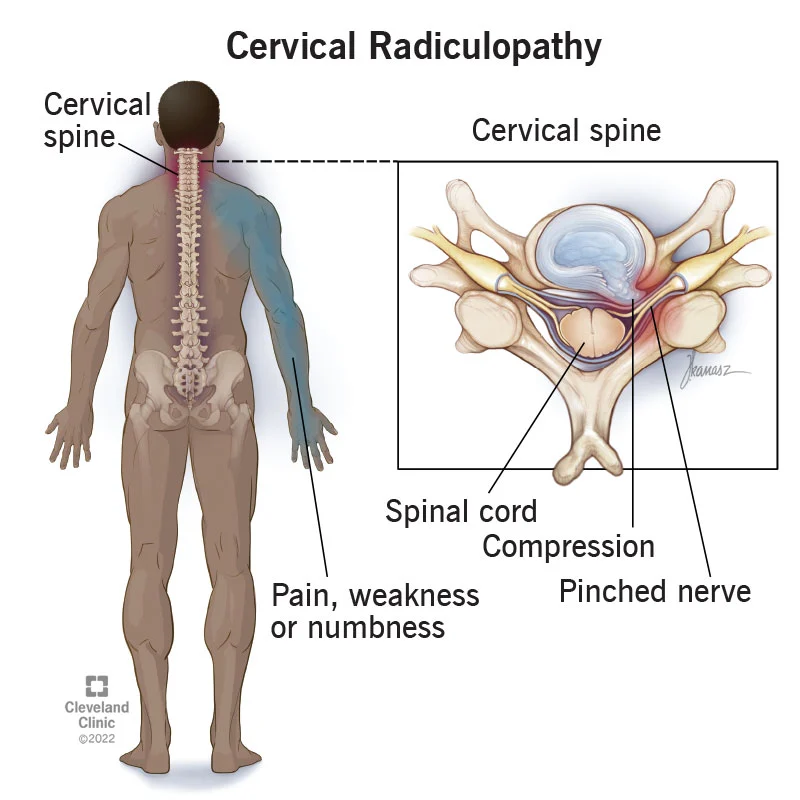 Comprehensive Guide to Effective Pinched Thoracic Nerve Treatment